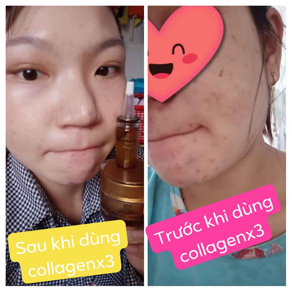 Combo dưỡng da, phục hồi hư tổn da (gồm Kem face Collagen x3 và Serum Collagen x3)