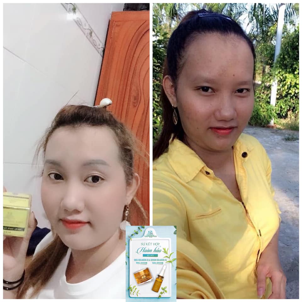 Combo dưỡng da, phục hồi hư tổn da (gồm Kem face Collagen x3 và Serum Collagen x3)