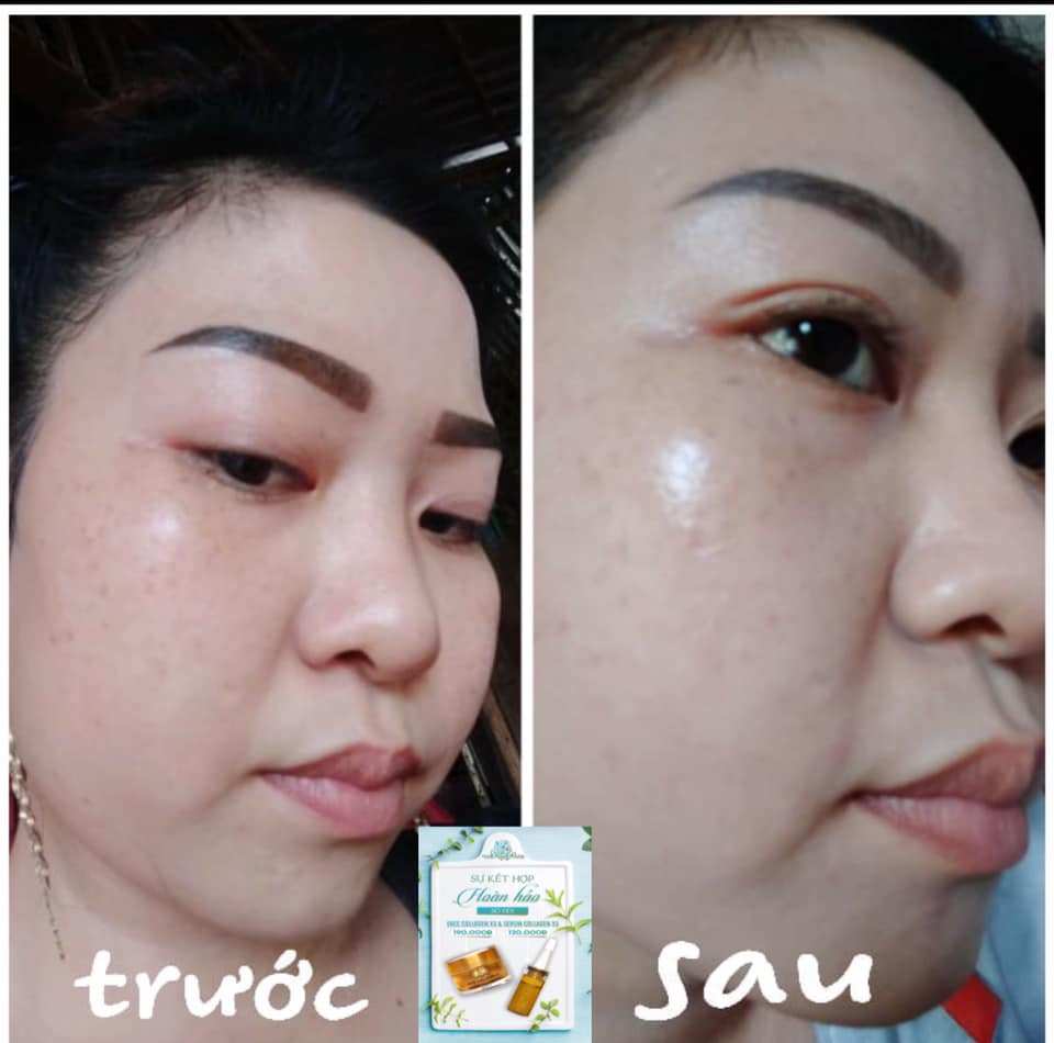 Combo dưỡng da, phục hồi hư tổn da (gồm Kem face Collagen x3 và Serum Collagen x3)