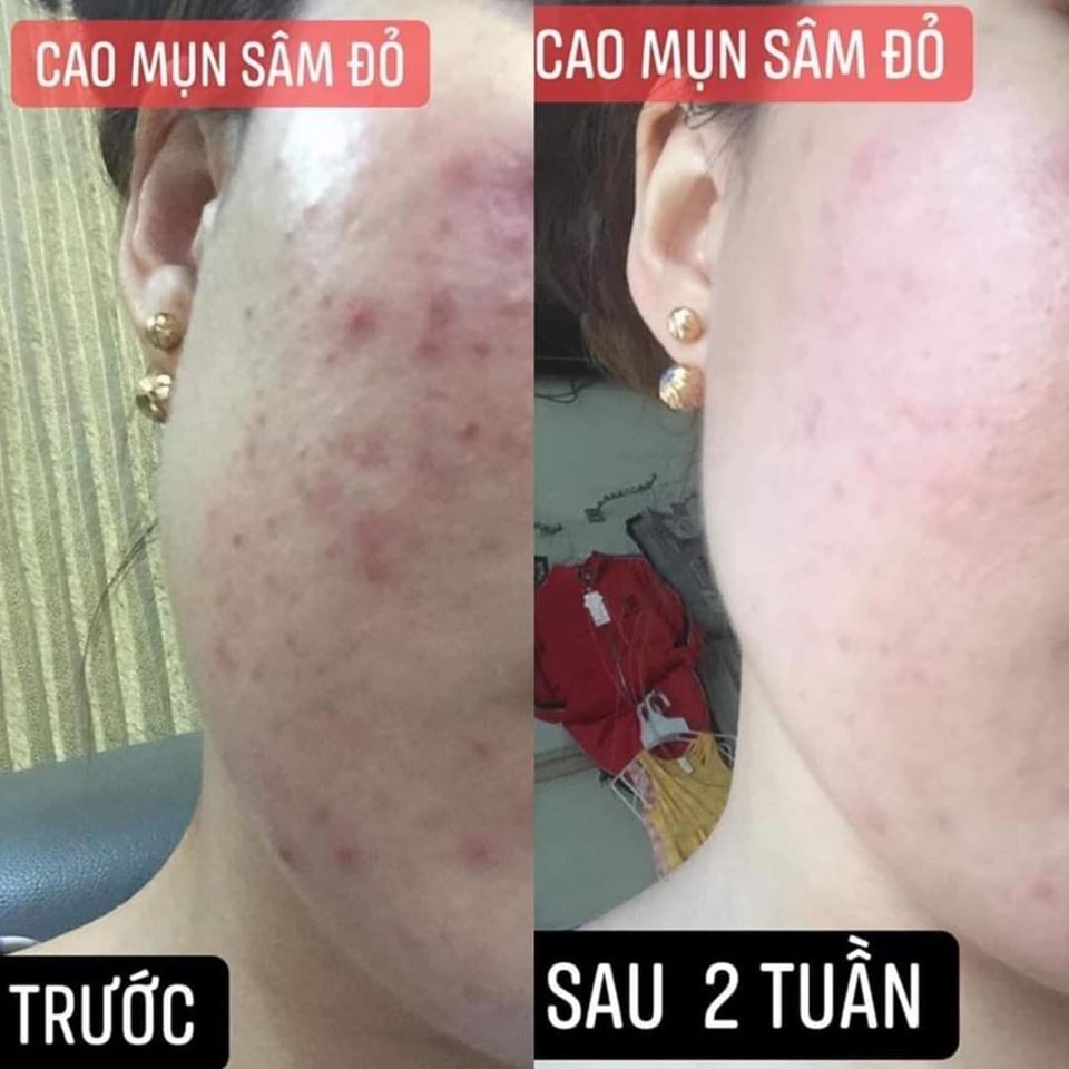 Cao mụn sâm đỏ - khắc tinh làn da mụn