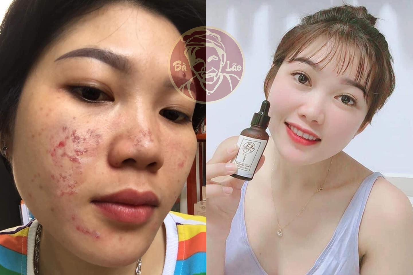 Serum trị mụn Bà Lão cho da Nhạy Cảm - Tái Tạo Cao Cấp