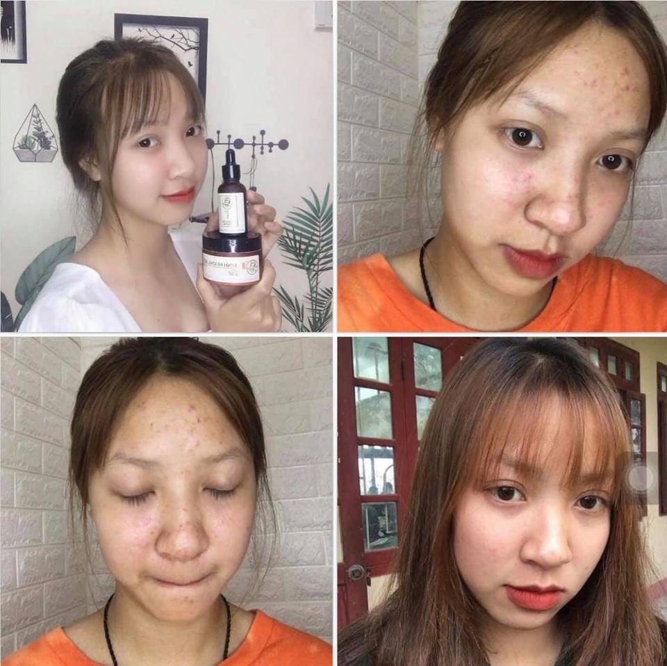 TRỊ MỤN BÀ LÃO - sản phẩm thảo dược thiên nhiên