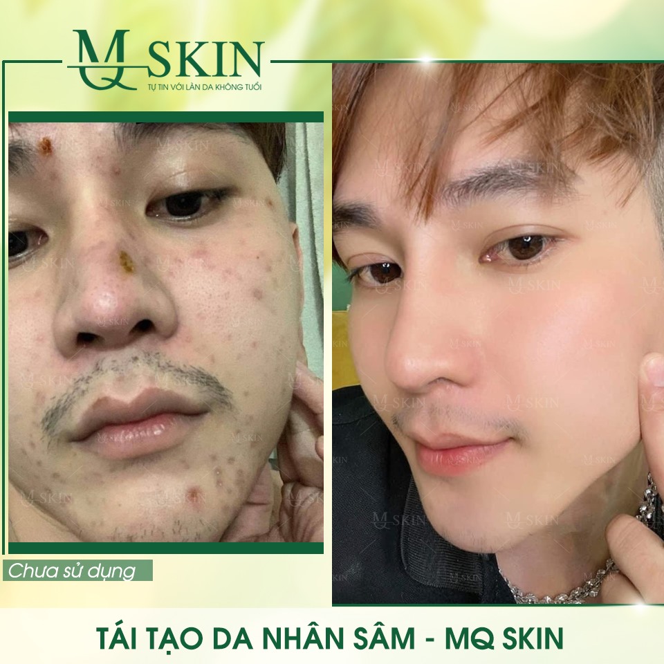 Vì sao "BB Cream tái tạo da MQ Skin" gây siêu bão trên thị trường?