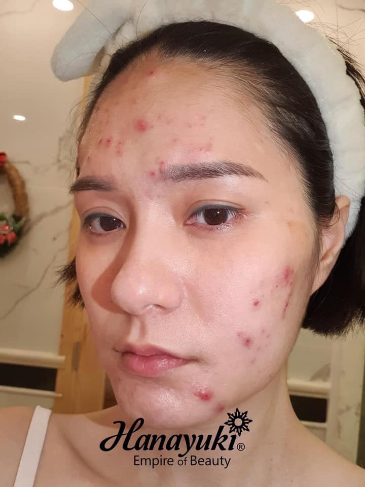 1 liệu trình 4 công dụng hiệu quả sau 7 ngày dùng với Hana Acnes