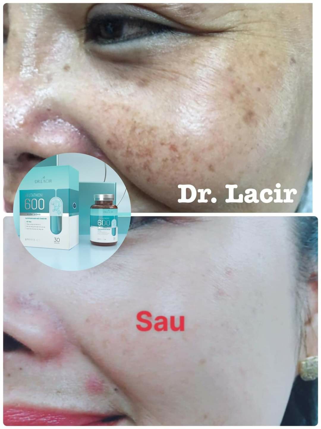 🌟 Giảm nám da với viên uống trắng da Dr Lacir không cần laser