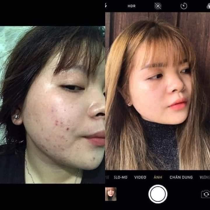 Trị mụn DR Mai vừa hợp túi tiền - vừa an toàn hiệu quả