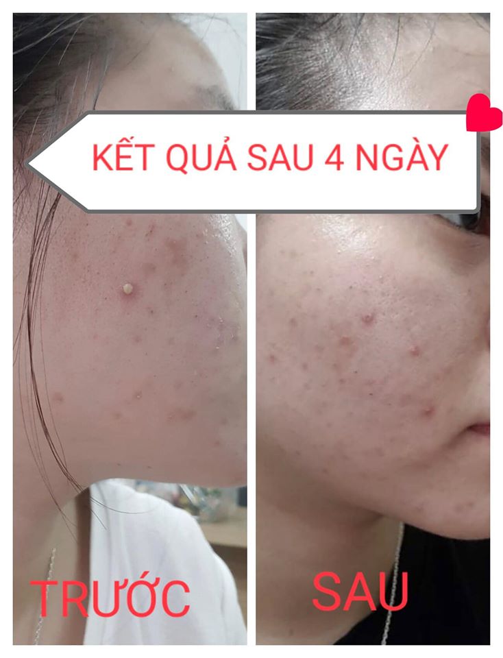 Dr Mai - bí quyết trị mụn trị thâm tận gốc từ thảo mộc thiên nhiên