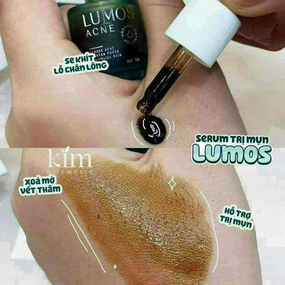 Serum Mụn Lumos Acne 5ml  Em này đúng chuẩn dũng sĩ diệt mụn luôn ạ