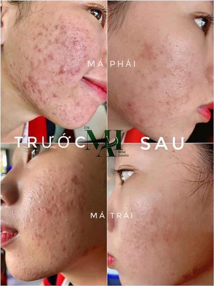 4 lý do - bất kỳ ai cũng cần 1 lọ Dr Mai trị mụn cho riêng mình