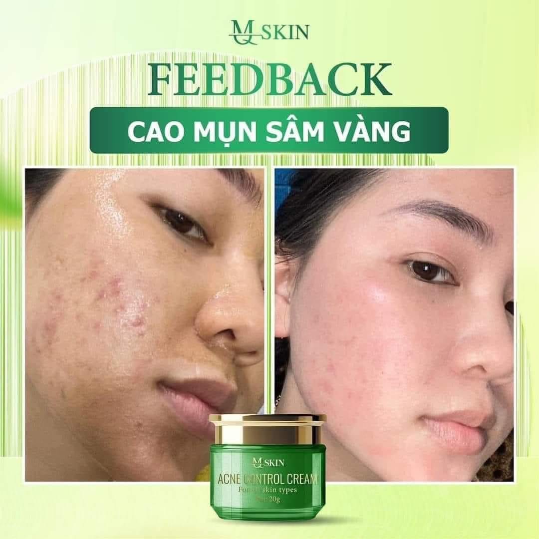 Cao Mụn Sâm Vàng MQ Skin hiệu quả trong việc chăm sóc da